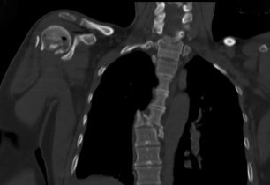 Druhá část výpovědi ženy, která přežila pád v Himálajích: zlomené obratle a problémy s pojišťovnou