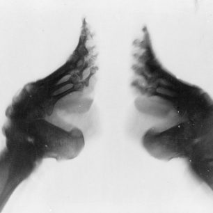 Rentgenová fotografie deformovaných nohou