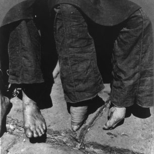 Čínské ženy ukazují rozdíl mezi normálníma a deformovanýma nohama