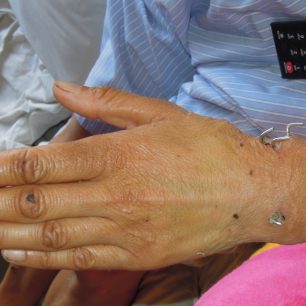 4 spony s háčkem zpevnily levé zápěstí