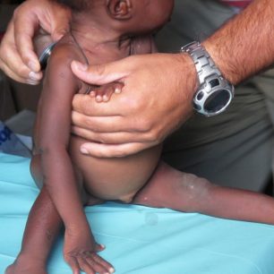 Vyšetřování podvýživeného dítěte v Malawi