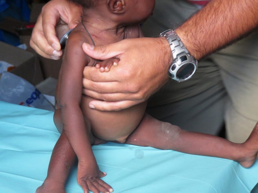 Vyšetřování podvýživeného dítěte v Malawi